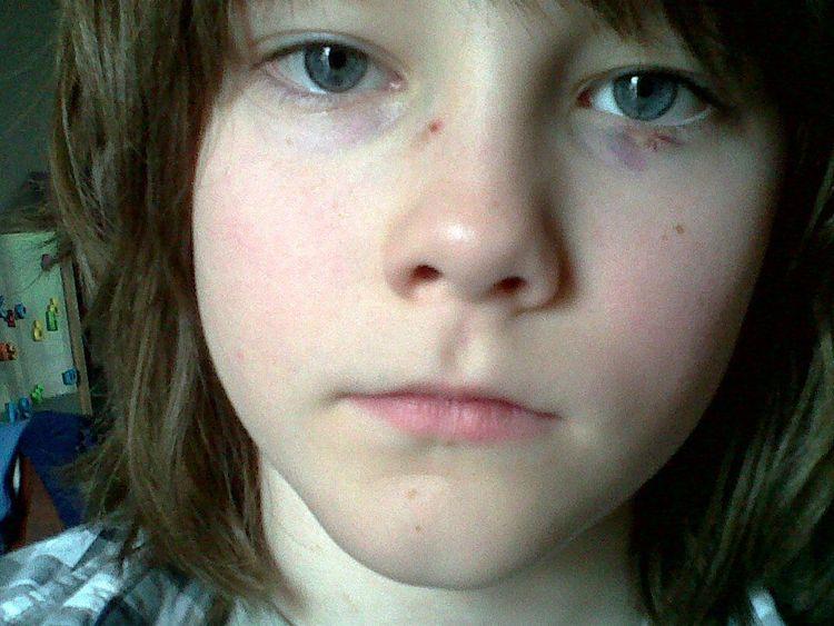 Me after surgery to fix my eye